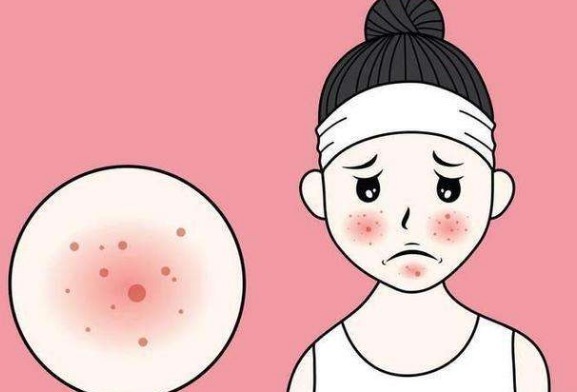 复合彩光|痤疮一直不好怎么办？这3条治疗痤疮的方法建议收好