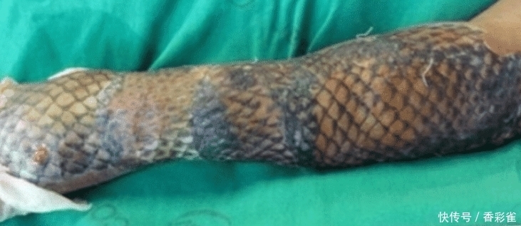 痊愈|女子全身被烧伤,医生植入“鱼皮”痊愈,网友:能美白吗?