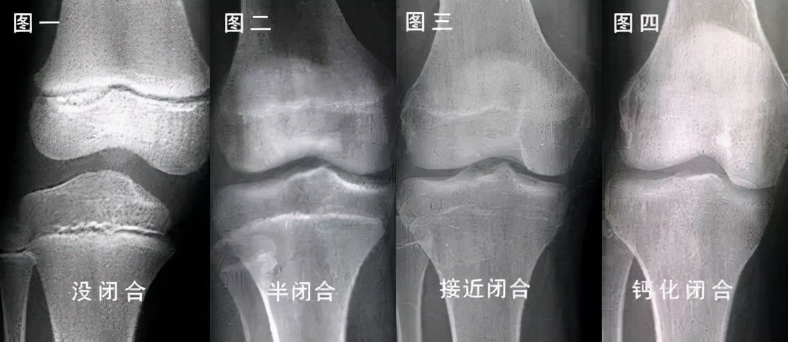 孩子|孩子个子的高矮与骨龄有关，骨龄偏小为什么会有利于孩子长高呢？