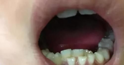 医生|2岁宝宝长出一口“鲨鱼牙”,宝妈痛哭求助,医生无奈:自作自受