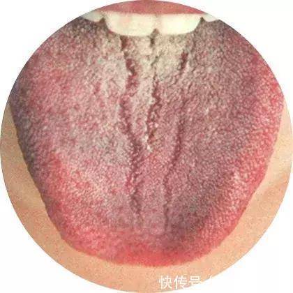 养舌|舌头总有裂纹,脾虚!一张方子,健脾养舌,令人深思