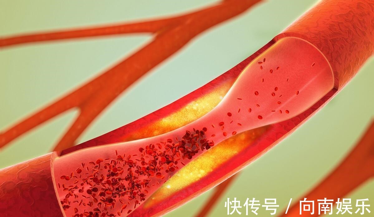 血管堵塞|常吃面条会升高血脂?医生提醒:血脂高的人,需要忌口3种食物