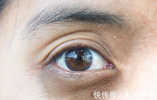 高血脂|血脂若升高，脸上或有3种反常，出现1种，劝你及时就医