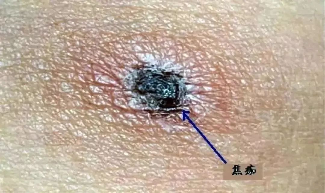 温州|温州一8岁女孩发烧休克，原来是被这种雨季最为活跃的虫子咬了