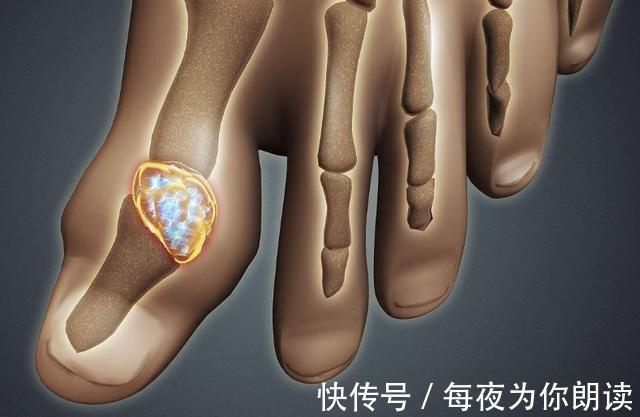 尿酸|再次强调痛风人群，4种食物不忌口，铁打的身体也扛不住