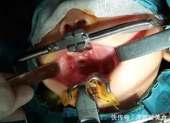 喉咙|小小一枚,孩子喉管被腐蚀!再说一遍,这些东西必须放好了