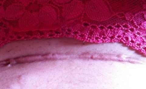 增生|结节、息肉、囊肿、增生...哪个才是癌症的先兆