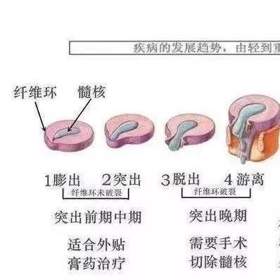  最为常见|你应该了解的腰间盘突出的知识，这样做，才能摆脱疼痛麻木
