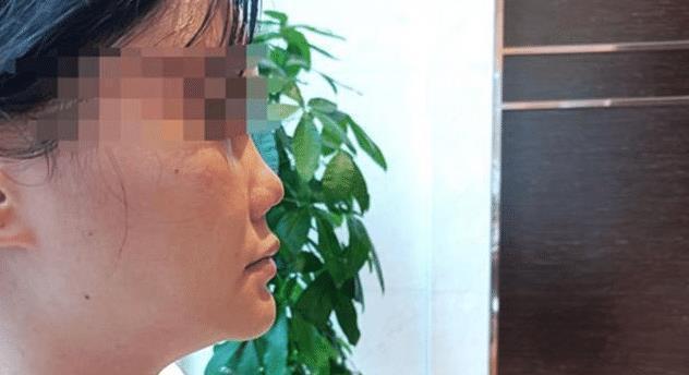 女子 女子整形感染后变“朝天鼻”,此前曾做过5次手术
