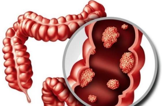 用药|长期吃泻药只为改善便秘?医生提醒:小心1种疾病找上门!