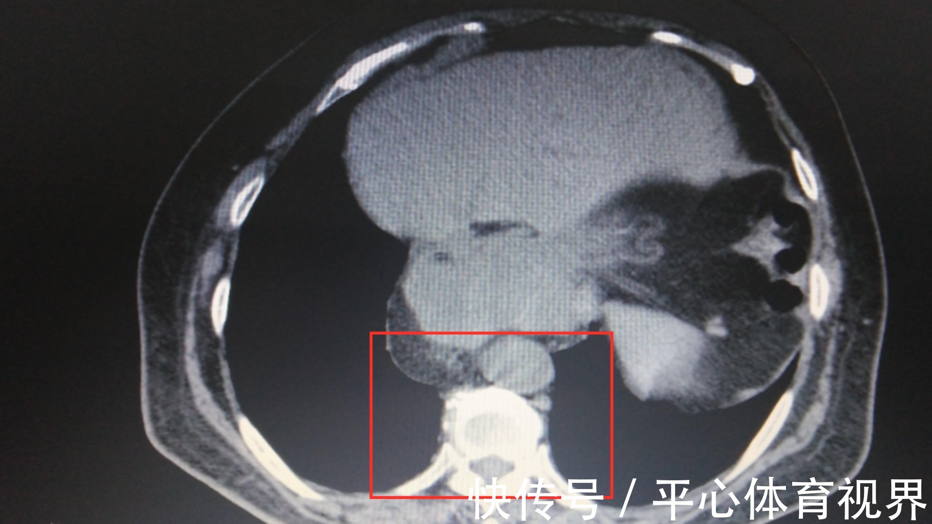 便血|发生了什么？女童上个洗手间，居然拉掉全身一半的血