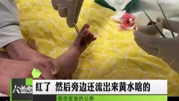 线头|2个月宝宝险被截肢,每小时放一次血!凶手竟是妈妈一根头发