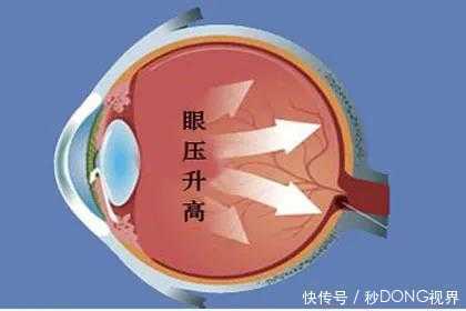 近视引起的这4大并发症,竟然还有这样的危害!