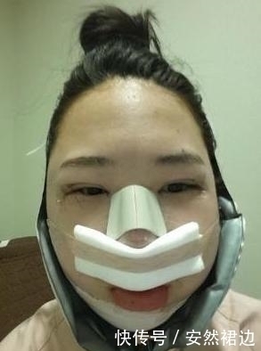 疼痛|小脸确实更可爱,看完整容过程,只觉得满屏的疼痛