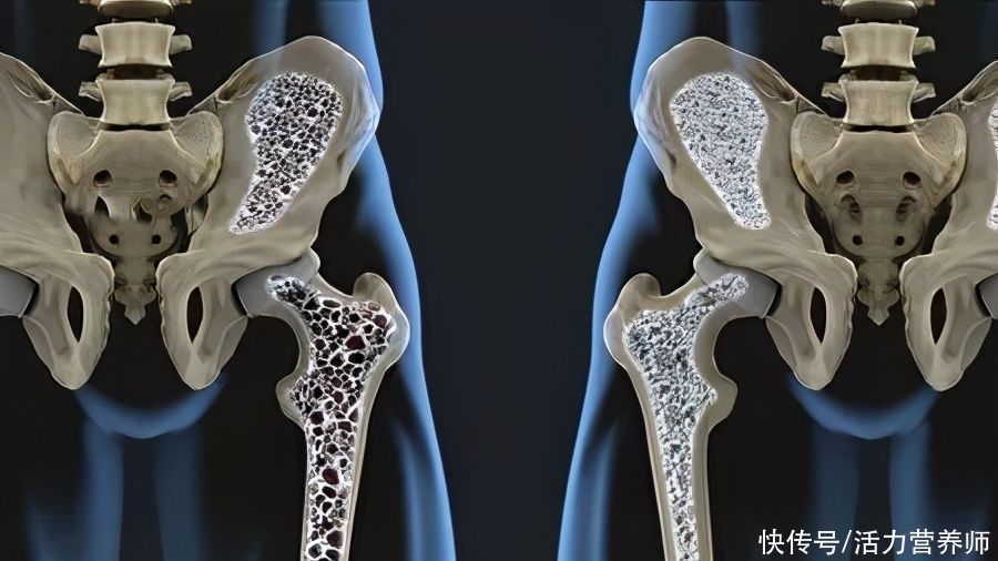 骨松质|人到中老年，预防骨质疏松多吃1种“零食”，关节不疼骨骼好