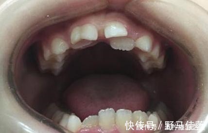 恒牙|7岁男孩乳牙未掉,恒牙又长,医生检查后说道幸亏来得及时