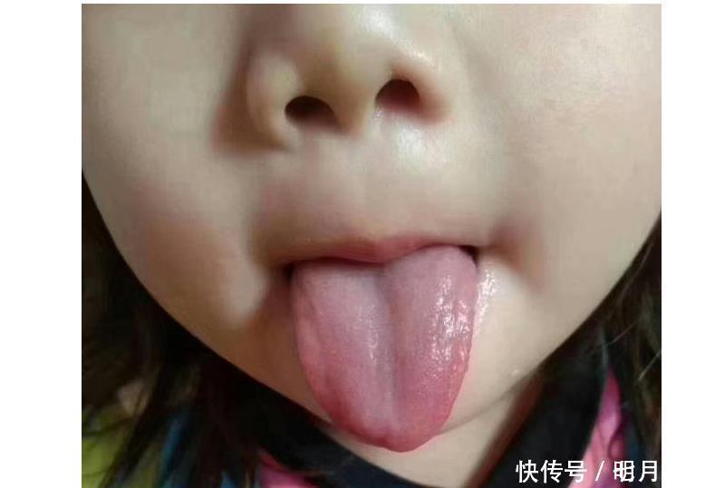 脾胃|4岁女童积食1年没长个，不爱零食，却贪食这物，埋下毒素