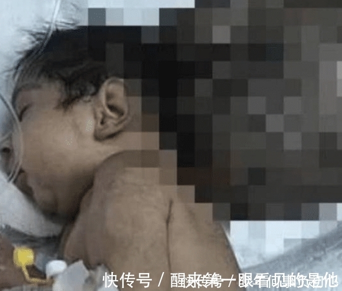 残疾|残疾小孩被父亲残忍掩埋,医生全力救助,心疼!