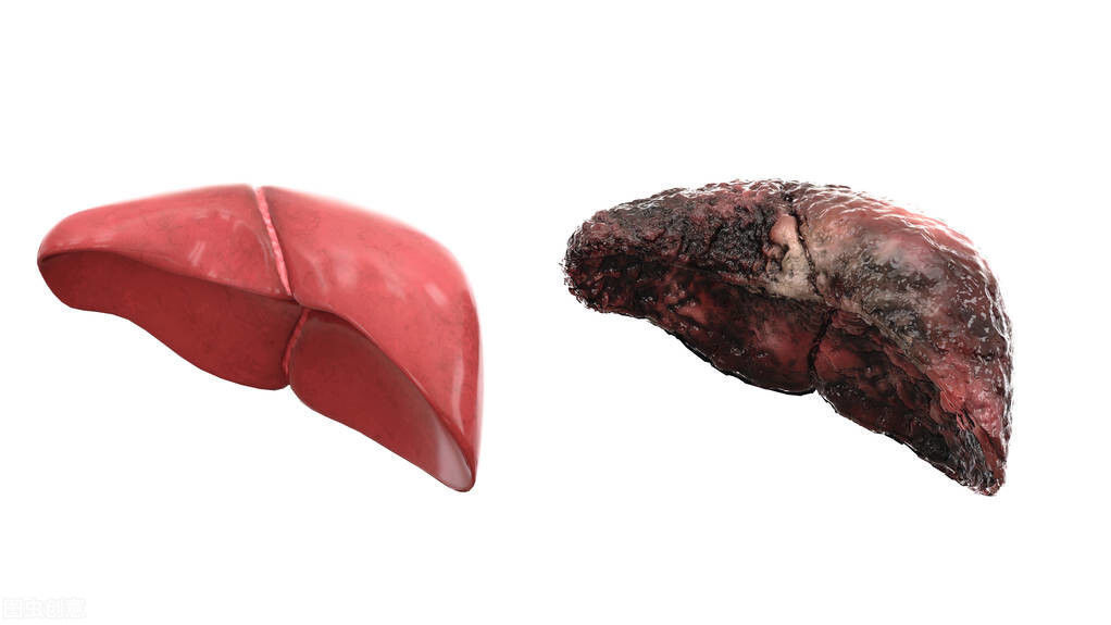  肝硬化|肝硬化的代偿期和失代偿期有什么不一样？主要有这5大区别