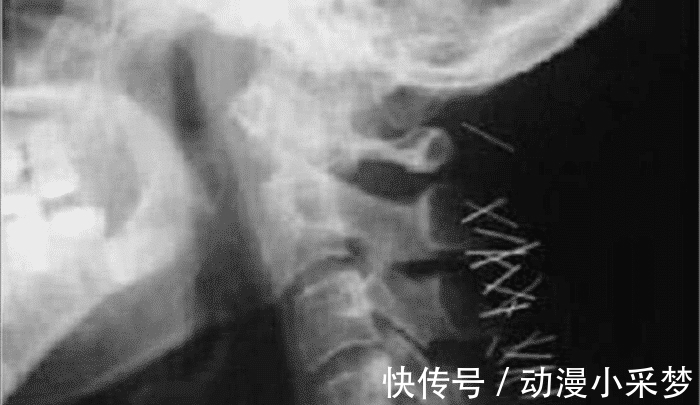 名侦探柯南|柯南:毛利小五郎究竟挨过多少针?看完后颈的CT照,网友:真坚强!