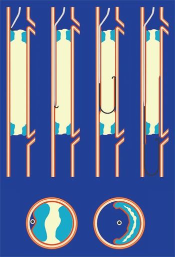 病变|放过他们的双脚,糖尿病足(五)治疗篇