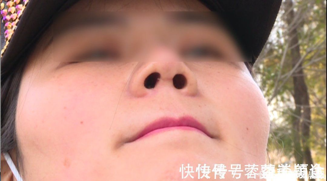 鼻子|花了近4万!女子取肋骨做的“欧美鼻”却变“妈生鼻”