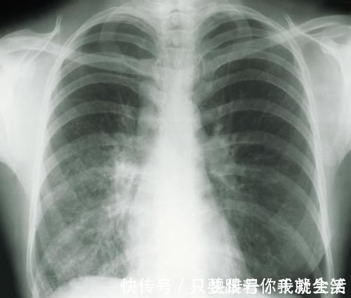 陈女士|女子双肺多发结节，一个已癌变！一旦查出这结节，建议尽快就医