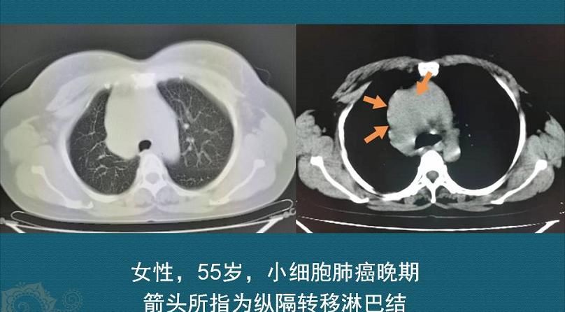  查出癌症不放疗不化疗，保持良好心态吃喝玩乐，能扛过去吗？