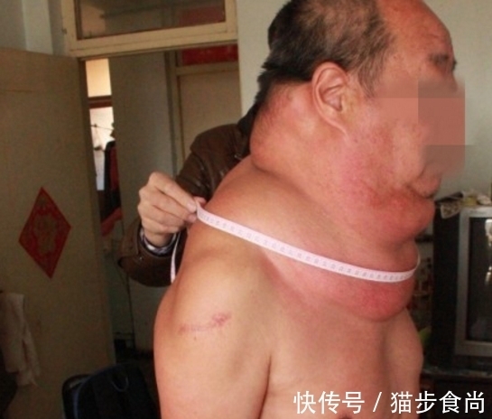 脖子|53岁大叔脖子粗成“水桶”,看起来样子很可怕,只因为疏忽一件
