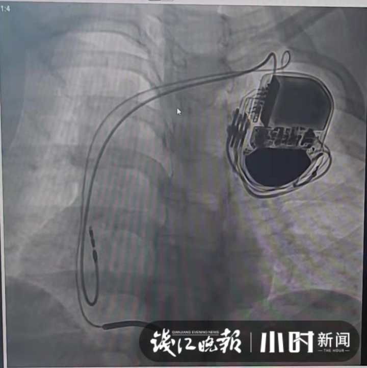 晕倒|终于有了平常“心”！姑娘每天晕倒几次，浙江衢化医院为她植入贴“心”管家