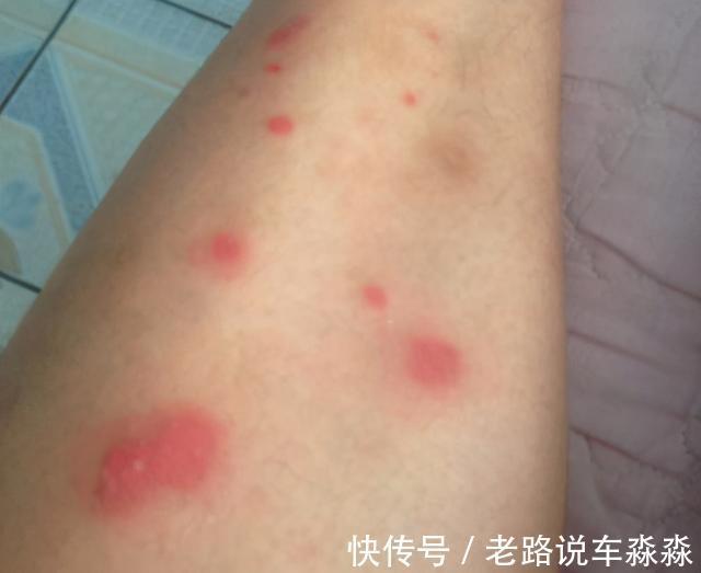 外感|过敏性湿疹怎么治疗?