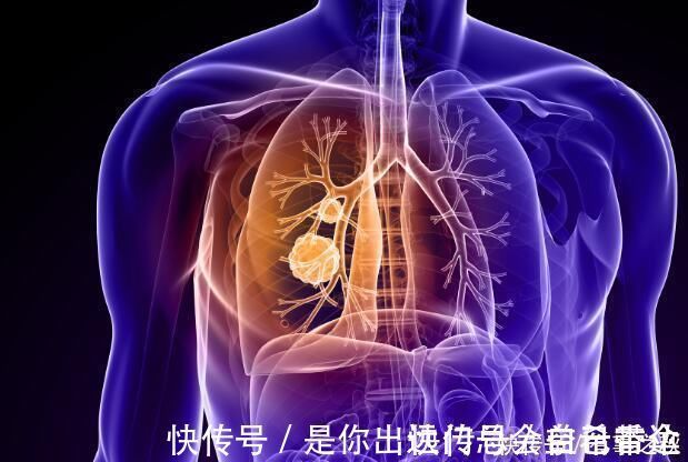 感冒|出现这种咳嗽, 别以为是感冒问题, 它可能是肺癌发出的信号!