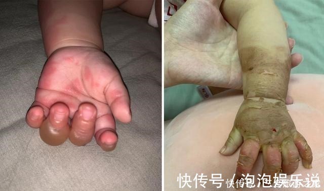 烫伤|宝宝不小心打翻热汤,这位妈妈下意识反应,将烫伤的伤害降到最低