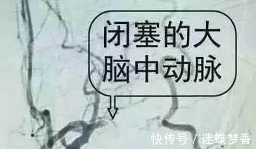 凝血因子|中风的“罪魁祸首”是血栓, 记牢两个字血栓不上身