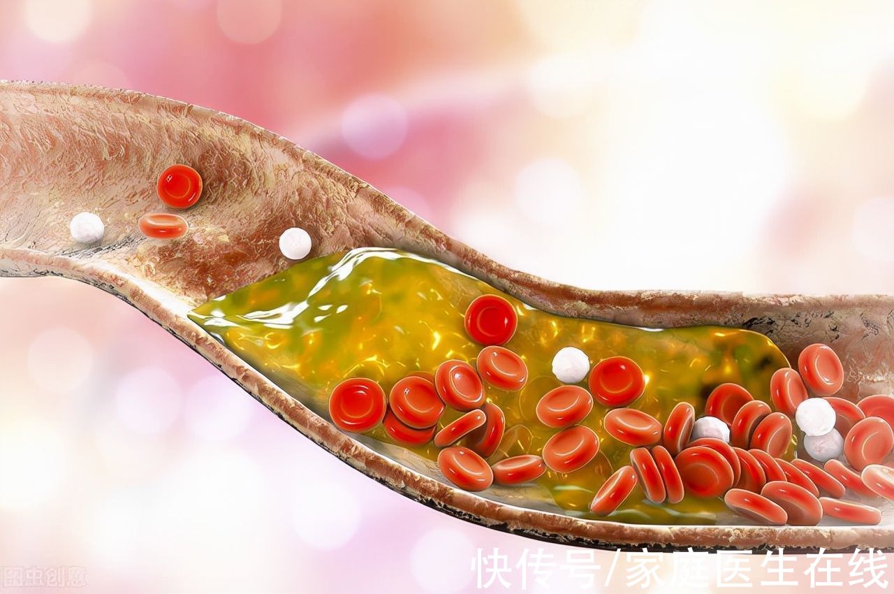 动脉|体内有个“不定时炸弹”？关于斑块的5个知识，建议提前了解一下