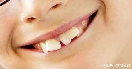 舌头|孩子牙不齐，多半是这4个坏习惯引起的，希望你家孩子一个都没有