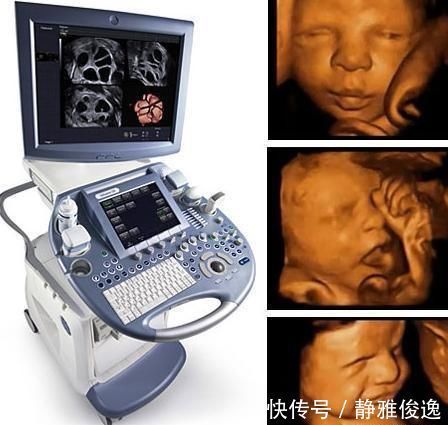 特征|唐氏儿在四维下的特征是什么,自己能不能感觉到胎儿的不正常?