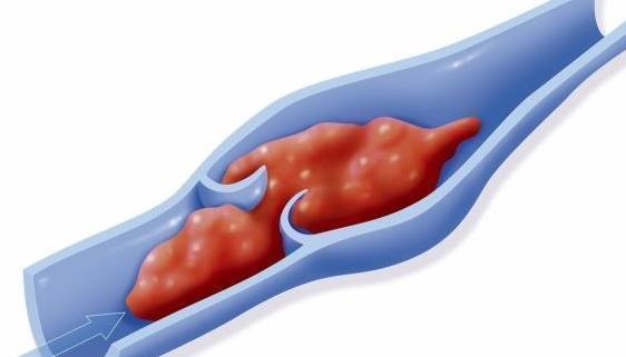 血栓|患血栓后不要担心,多吃些天然的阿司匹林,帮助疏通血管全身放松