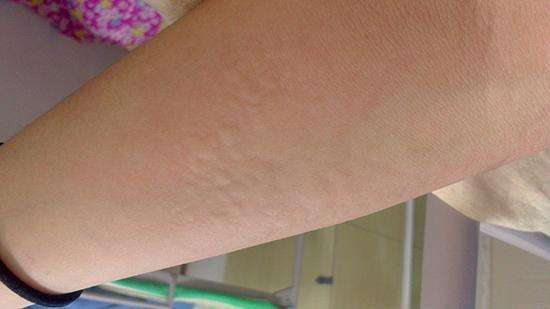 肌表|吃完鱼虾起风疹！一味粪便类中药，化湿浊，祛风邪，值得研究