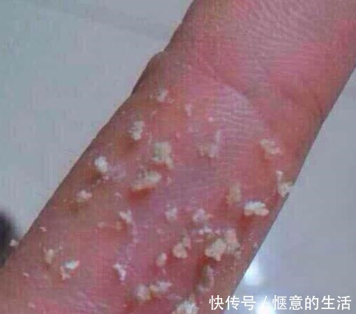 氨基酸洗面奶|先别慌着挤黑头,这3种原因你知道了再挤也不迟!