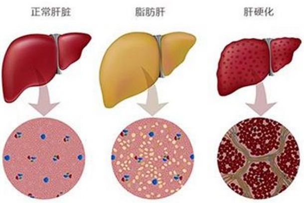 脂肪肝，肝硬化怎么办?中医：少吃4物，多吃“它”肝会“感激”你