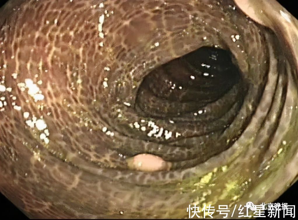 结肠黑变病|豹纹?蛇皮?她吃了3年这种“药”,肠子表面变成…