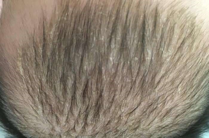 小丽|刚满月的宝宝就高烧不退!医生看到宝宝的头皮后怒斥她不配做妈妈