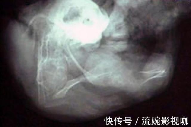 胎儿|7岁女孩后背长个“包”,父母带娃去医院检查,医生三胞胎老大