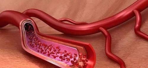 克星|血栓的“克星”被发现了,经常吃一点,血液干净,血栓不来扰