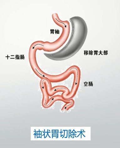 减重|【招募】“寻找第一胖友”公益活动招募中，免费安全的减重手术等你来