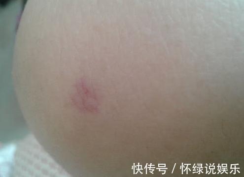 病变|如果你身上出现了2种痣,可能是肝脏病变,不注意就迟了