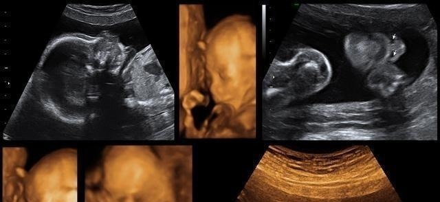 睡眠时间|做四维时宝宝趴着不愿意动,原来是这些原因,做好这点一次通过