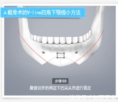 操作方法 下巴截骨术危险吗?手术注意事项须知及术后怎么护理?看完全明白了!
