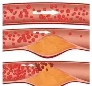 血液|德国颠覆性研究：动脉硬化斑块并非来自血液中的脂肪